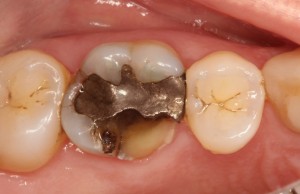 Broken Tooth - Cracked Cusp