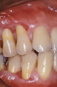 Traumatised gum due to toothpicks