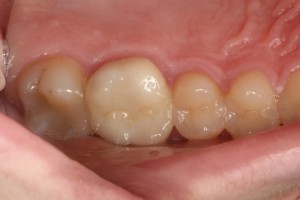 Zirconia crown on molar