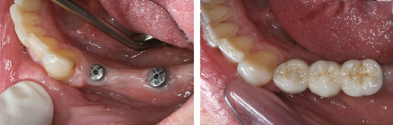 replacing multiple teeth dental implants