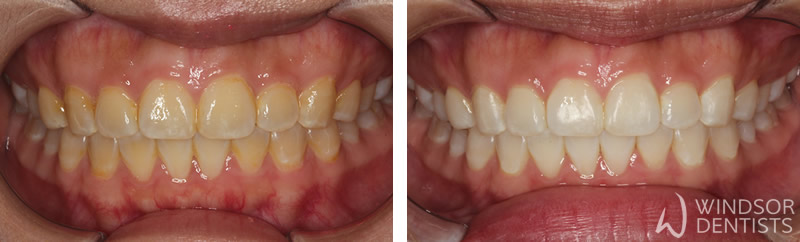 tooth whitening before after