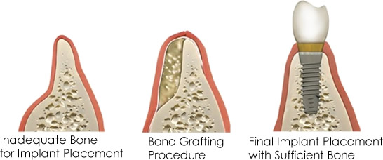 bone grafting procedure