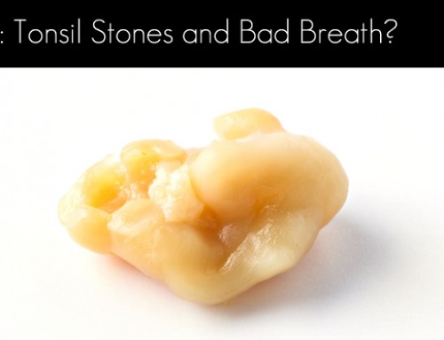 I Have Tonsil Stones and Bad Breath
