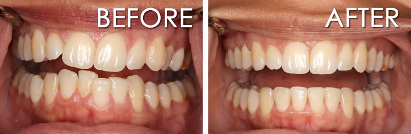 invisalign before and after crowding