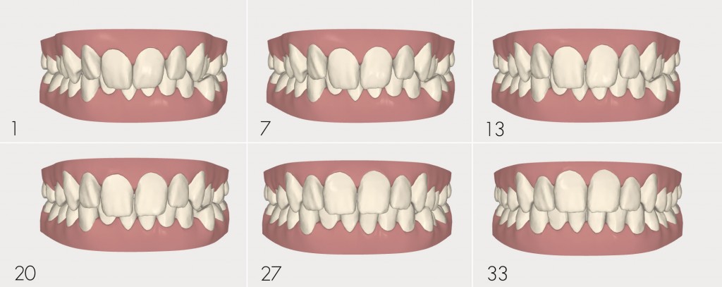 invisalign series tooth movement