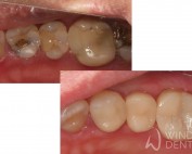 Replacing leaking white composite fillings