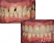 full mouth reconstruction with porcelain crowns