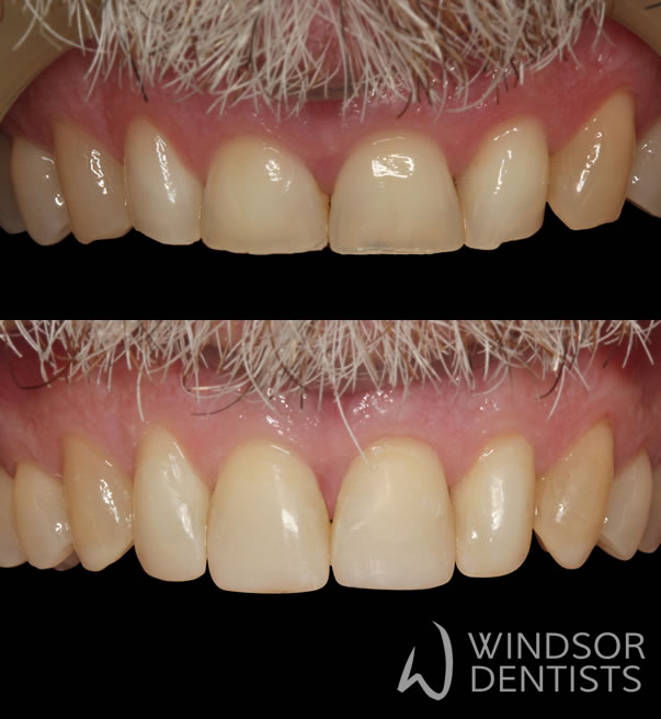 worn front teeth composite veneers before after