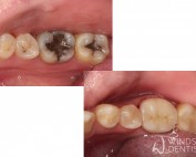 zirconia crown and white composite fillings