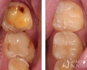 Worn sensitive teeth restored with conservative composite fillings