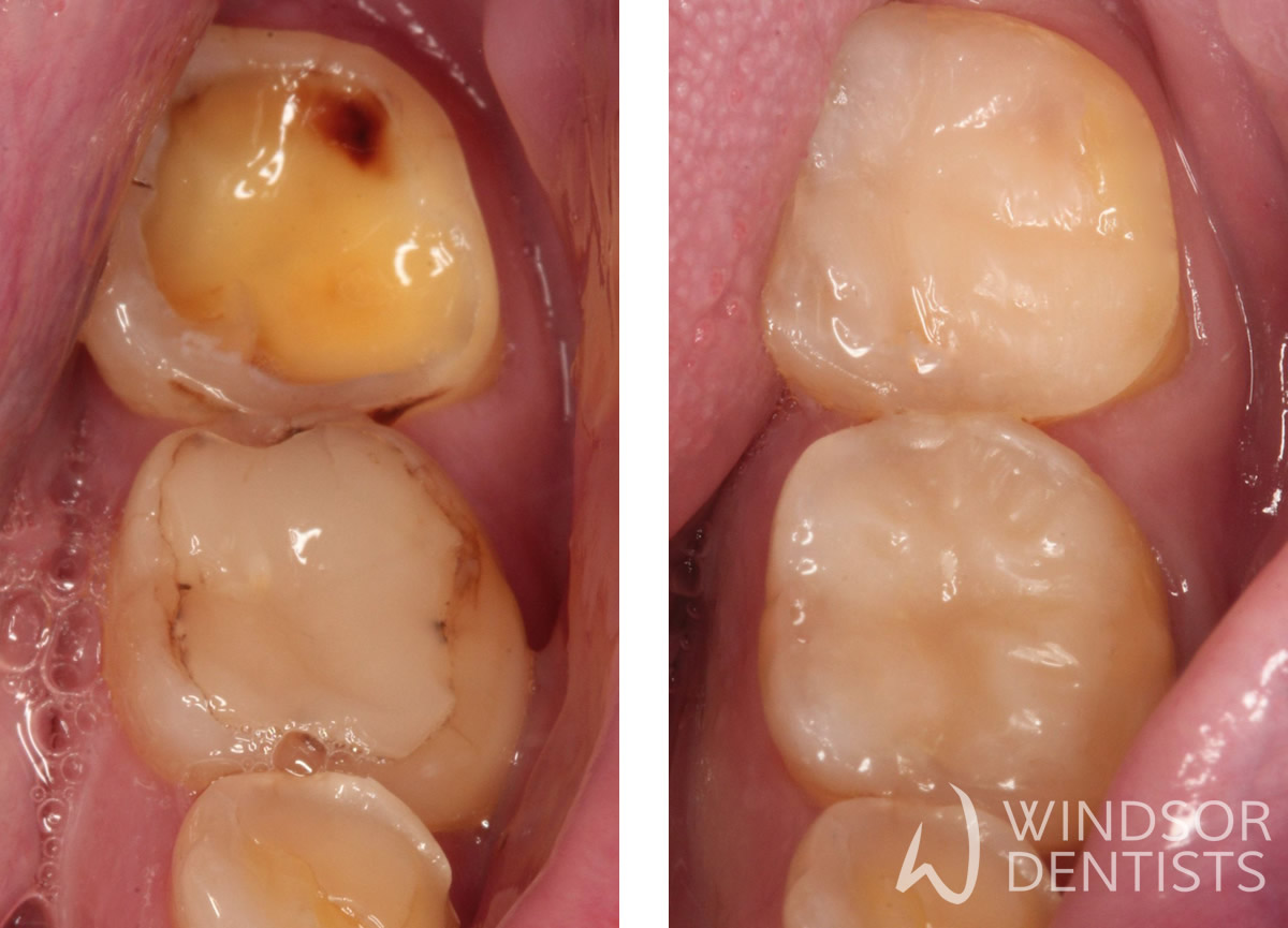 Worn sensitive teeth restored with conservative composite fillings