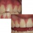 dental trauma chipped teeth