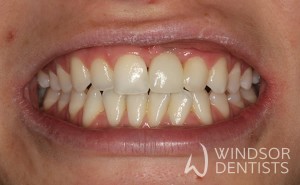 dental implant missing front tooth after