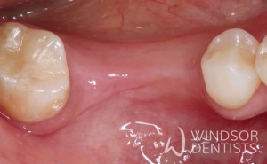 multiple dental implants before