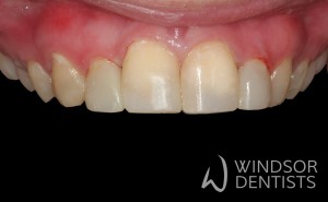 tooth decay and composite veneers after