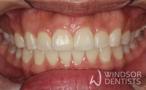 tooth whitening after