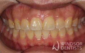 tooth whitening before