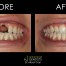 dental implant replacing front missing tooth