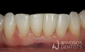 black triangle after bioclear