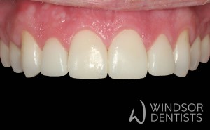 gappy teeth after porcelain veneers