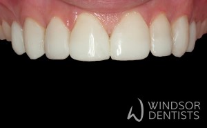 tooth wear composite veneer build up after