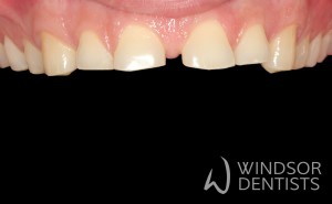 tooth wear composite veneer build up before