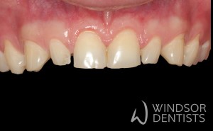 tooth wear bruxism before